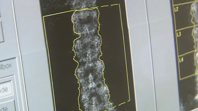 Health Check: Stem cells linked to osteoarthritis